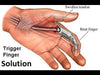 Finger Splints used for Trigger Finger Treatment - 2019 Review of Top 5 Arrow Splints